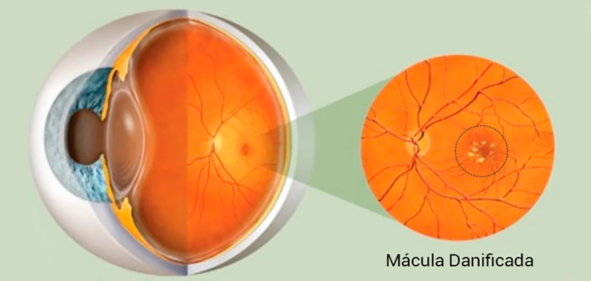 Degeneração Macular | Instituto Baiano de Visão - Salvador e Lauro de ...